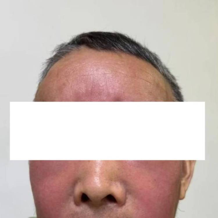 皇冠信用網代理流程_杭州发生多起皇冠信用網代理流程!面部肿成“馒头”!6小时内处理很重要