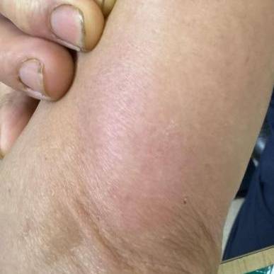 皇冠信用網代理流程_杭州发生多起皇冠信用網代理流程!面部肿成“馒头”!6小时内处理很重要