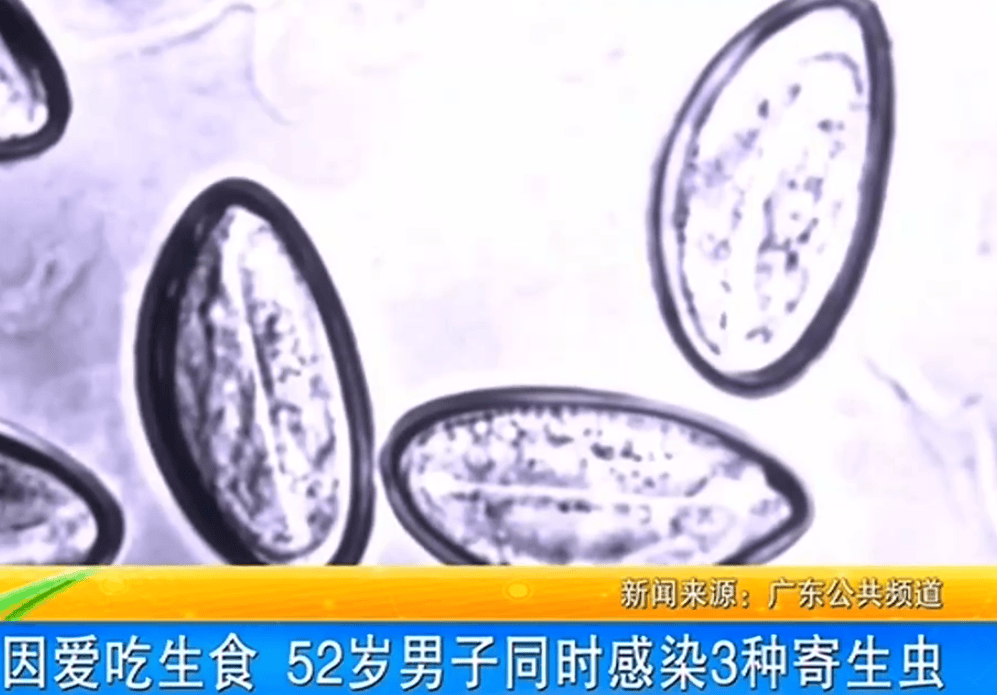 皇冠信用網会员开户_女子体内排出10米长绦虫皇冠信用網会员开户!原是两年前旅游时吃了这种食物