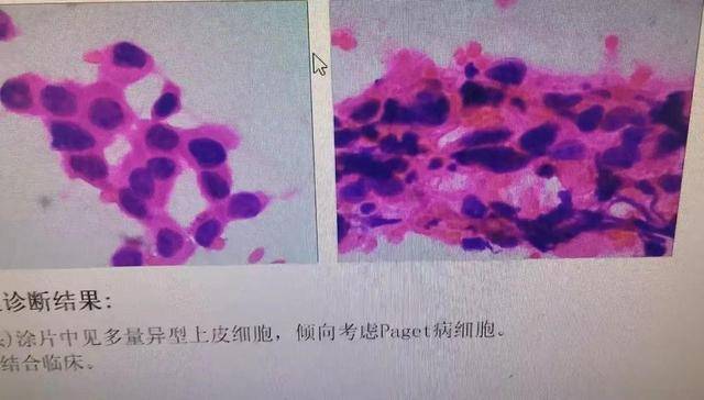 皇冠信用盘怎么弄
_以为是湿疹皇冠信用盘怎么弄
,结果竟是癌!宁波女子悔惨:反复涂了一年药膏都没好!很多患者首诊都去了皮肤科